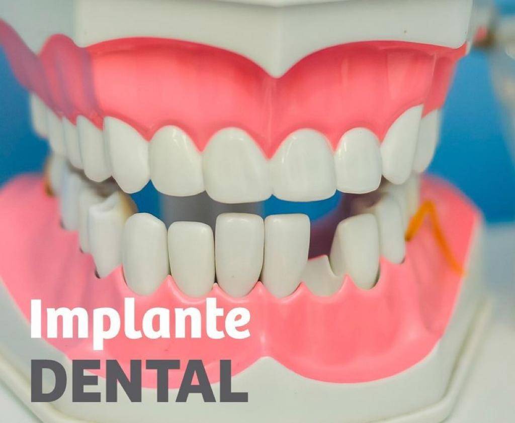 los implantes dentales