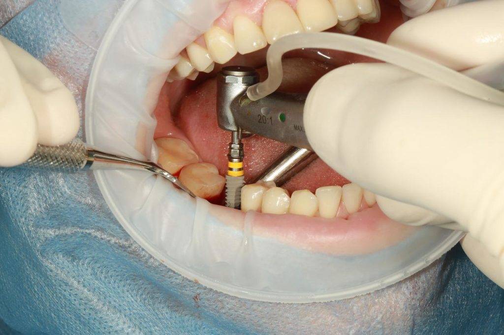 ponerse implantes dentales