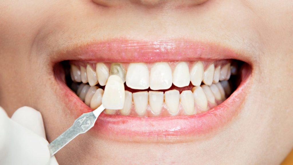 las ventajas de las carillas dentales