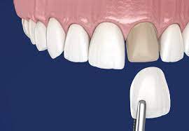 las ventajas de las carillas dentales