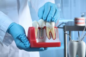duración de los implantes dentales