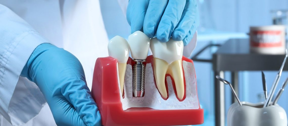 duración de los implantes dentales